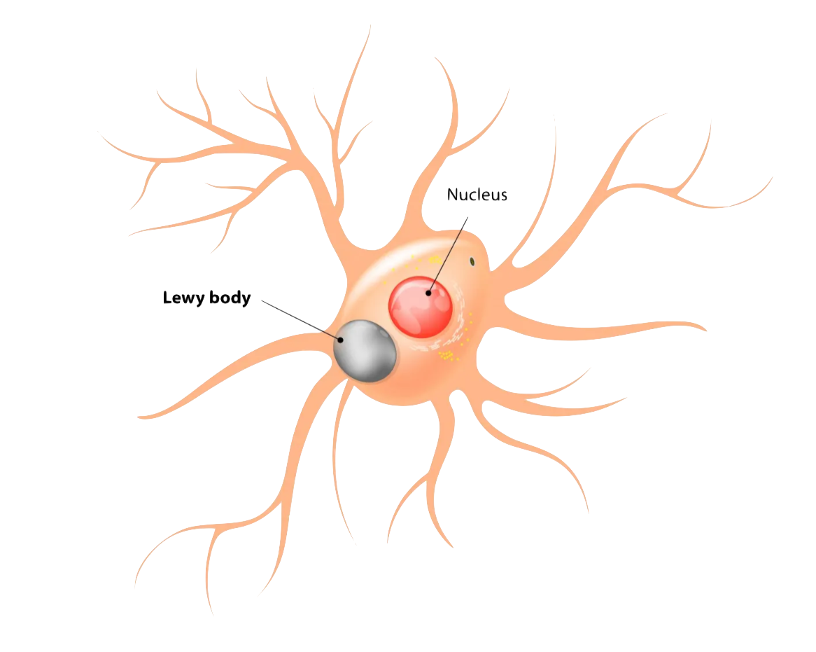 Neuron with Lewy Body