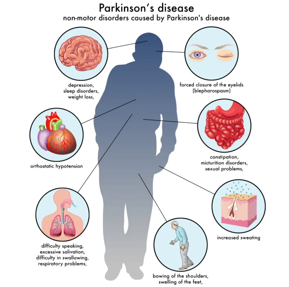 Parkinson's symptoms diagram